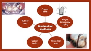 Mechanical
methods
Copper
band
Acrylic
temporary
coping
Retraction
cord
Cotton
twills
Rubber
dam
 