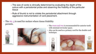 • The size of cords is clinically determined by evaluating the depth of the
sulcus with a periodontal probe and observing the friability of the particular
tissue
• Rule of thumb is not to violate the periodontal attachment through
aggressive instrumentation of cord placement.
 