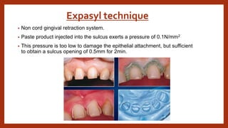 Expasyl technique
• Non cord gingival retraction system.
• Paste product injected into the sulcus exerts a pressure of 0.1N/mm2
• This pressure is too low to damage the epithelial attachment, but sufficient
to obtain a sulcus opening of 0.5mm for 2min.
 