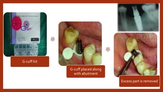 G-cuff kit
G-cuff placed along
with abutment
Excess part is removed
 