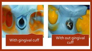With gingival cuff
With out gingival
cuff
 