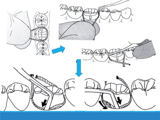GINGIVAL RETRACTION in fixed prosthodontics | PPT