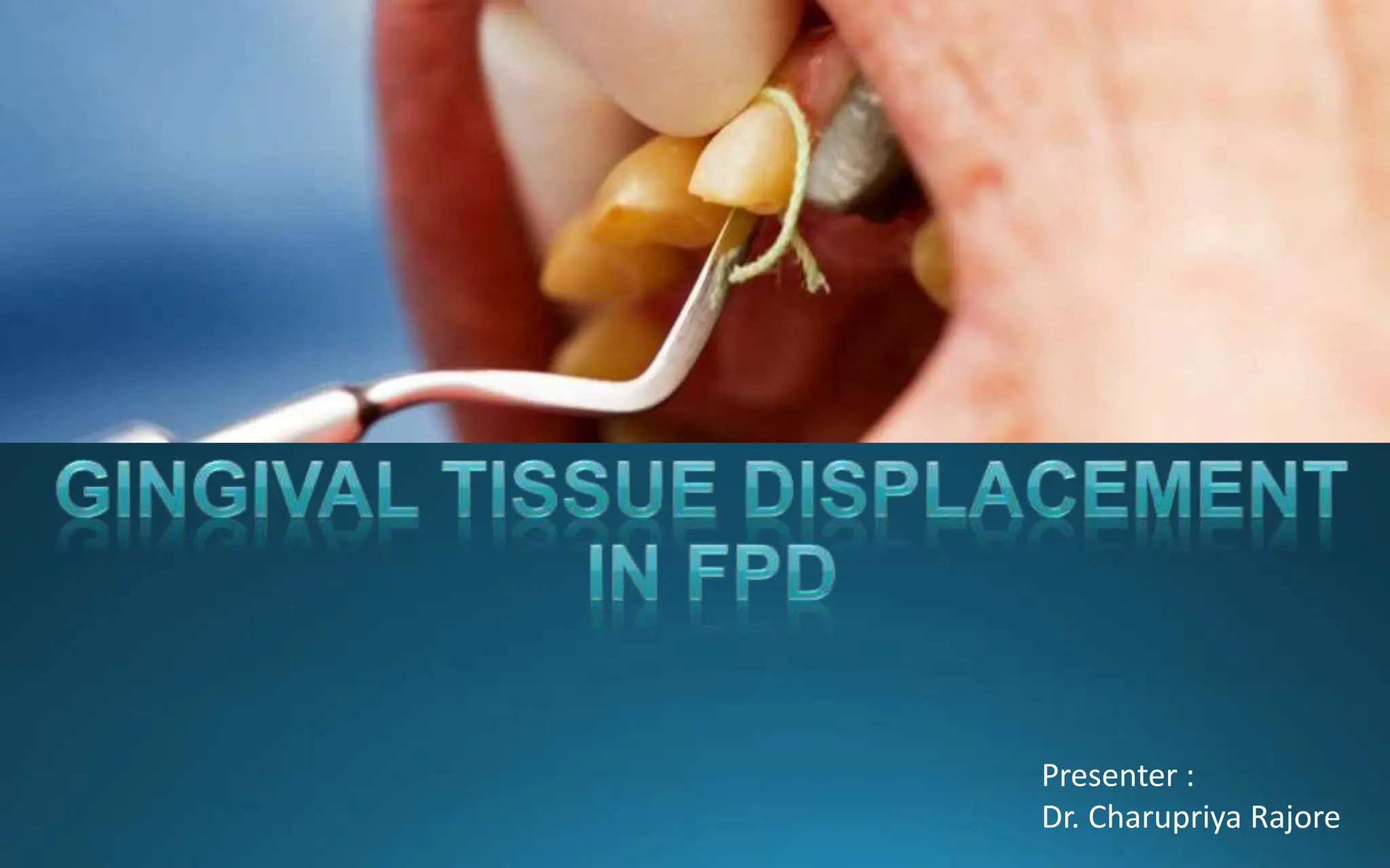 gingival retraction seminar pptx gingival displacment methods ppt PPT