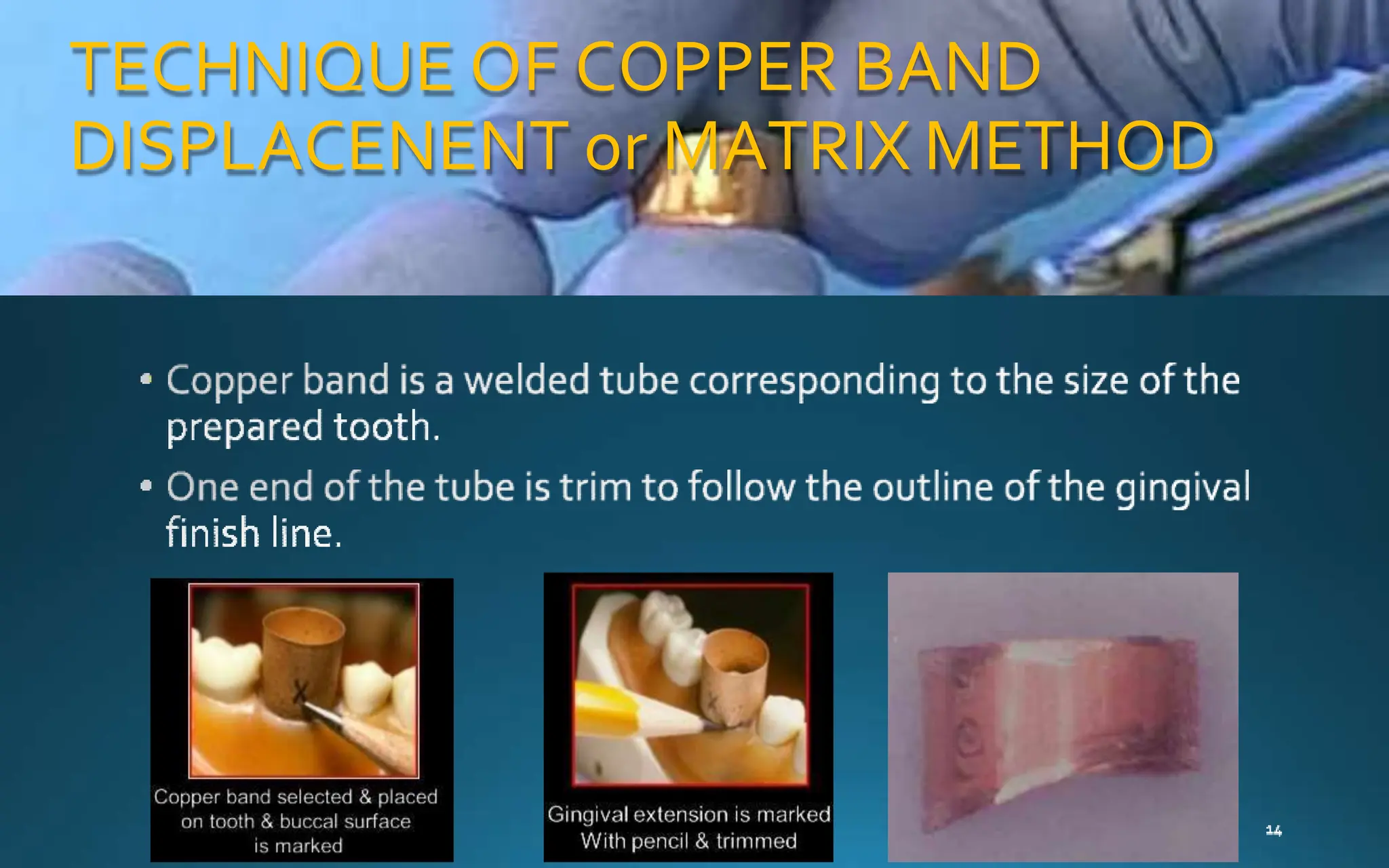 TECHNIQUE OF COPPER BAND
DISPLACENENT or MATRIX METHOD
 