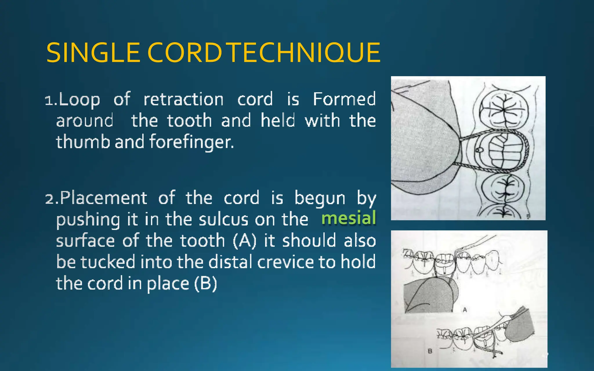 SINGLE CORDTECHNIQUE
mesial
 
