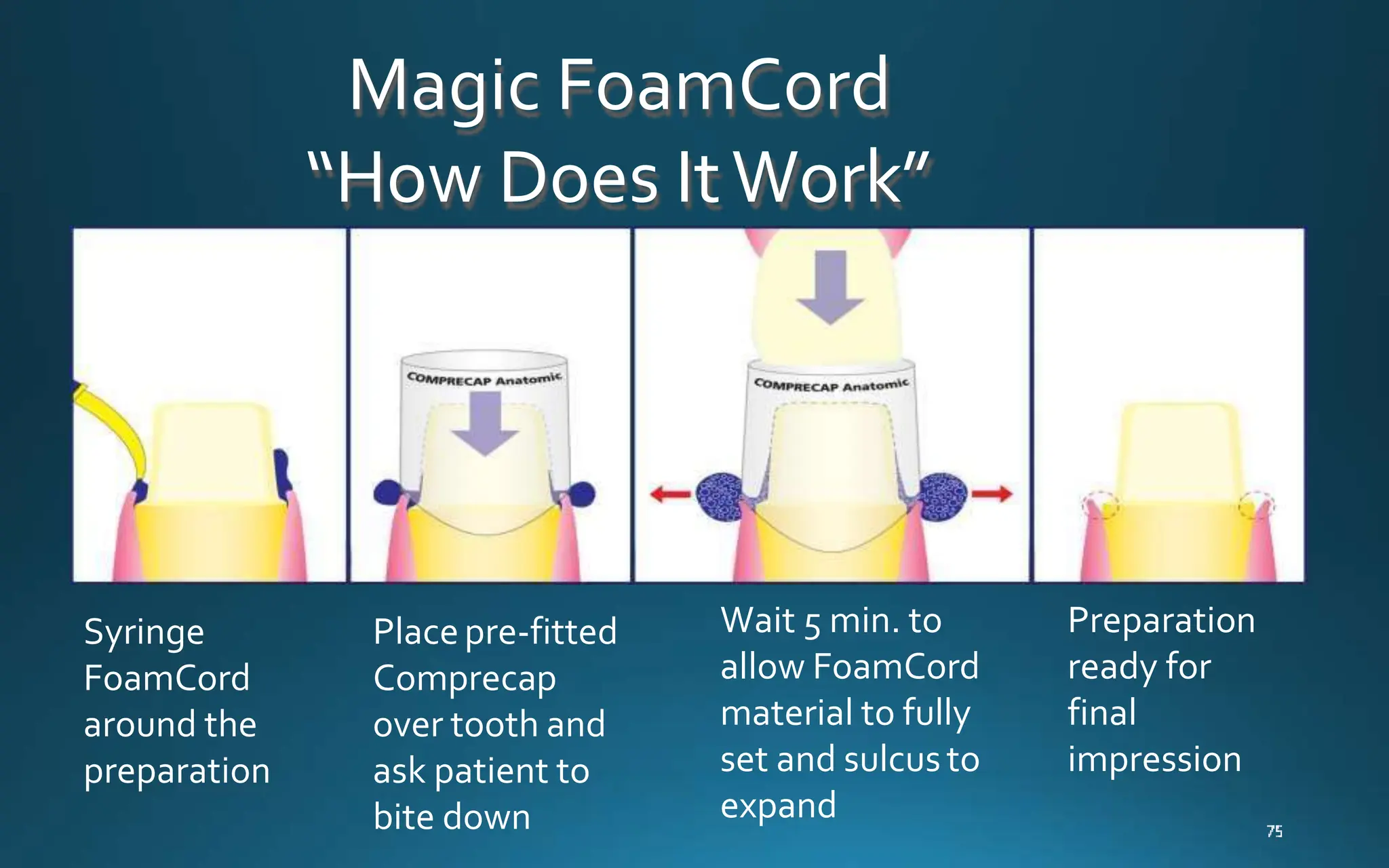 Magic FoamCord
“How Does ItWork”
Syringe
FoamCord
around the
preparation
Placepre-fitted
Comprecap
over tooth and
ask patient to
bite down
Wait 5 min. to
allow FoamCord
material to fully
set and sulcusto
expand
Preparation
ready for
final
impression
 