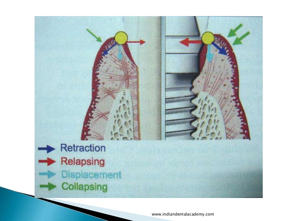 Gingival retraction techniques for implants versus teeth/ cosmetic de…