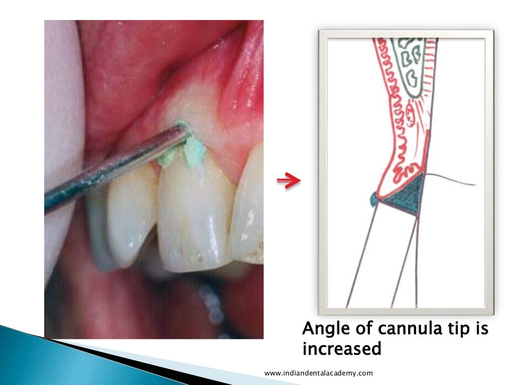 Gingival retraction techniques for implants versus teeth/ cosmetic de…