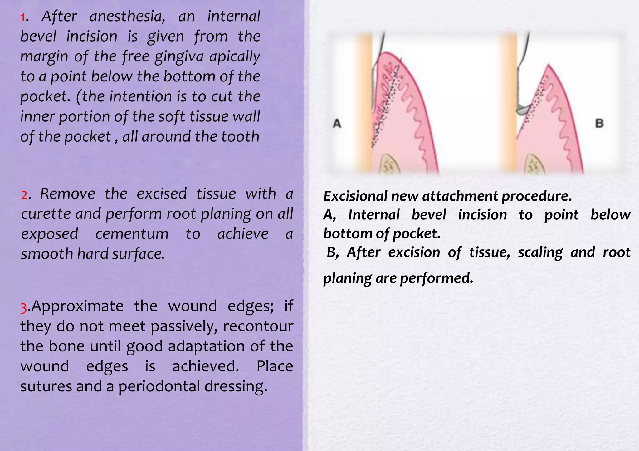 Gingival surgical techniques | PPTX