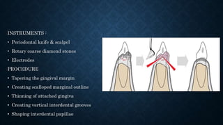 INSTRUMENTS :
• Periodontal knife & scalpel
• Rotary coarse diamond stones
• Electrodes
PROCEDURE
• Tapering the gingival margin
• Creating scalloped marginal outline
• Thinning of attached gingiva
• Creating vertical interdental grooves
• Shaping interdental papillae
 