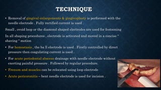 TECHNIQUE
• Removal of gingival enlargements & gingivoplasty is performed with the
needle electrode . Fully rectified current is used .
Small , ovoid loop or the diamond shaped electrodes are used for festooning
In all shaping procedures , electrode is activated and moved in a concise “
shaving “ motion
• For hemostasis , the ba ll electrode is used . Firstly controlled by direct
pressure then coagulating current is used .
• For acute periodontal abscess drainage with needle electrode without
exerting painful pressure . Followed by regular procedure.
• Frenum and muscles can be relocated using loop electrode
• Acute pericoronitis – bent needle electrode is used for incision .
 
