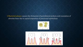 Bacterial plaque causes the formation of periodontal pockets and resorption of
alveolar bone due to apical migration of junctional epithelium
 