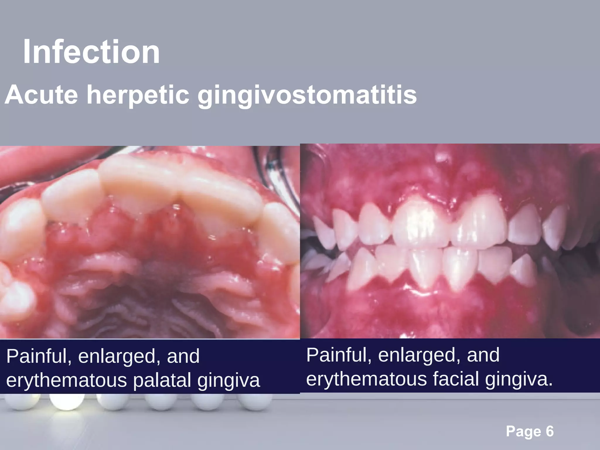 Palatal Infection Gingival swellings differential diagnosis | PPT