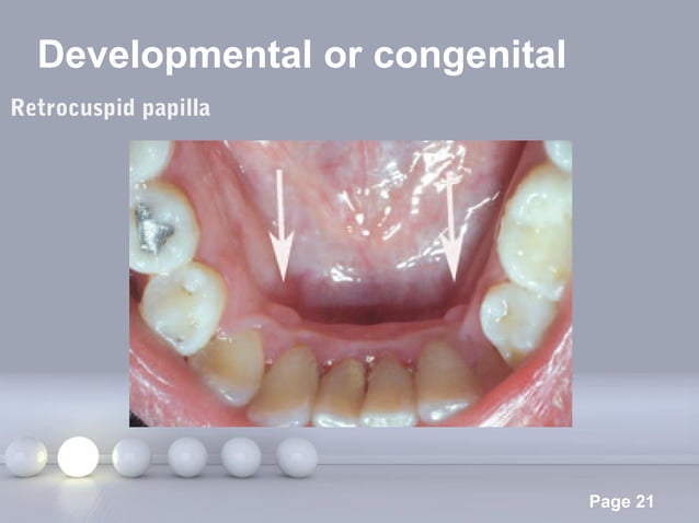 Gingival Swellings Differential Diagnosis