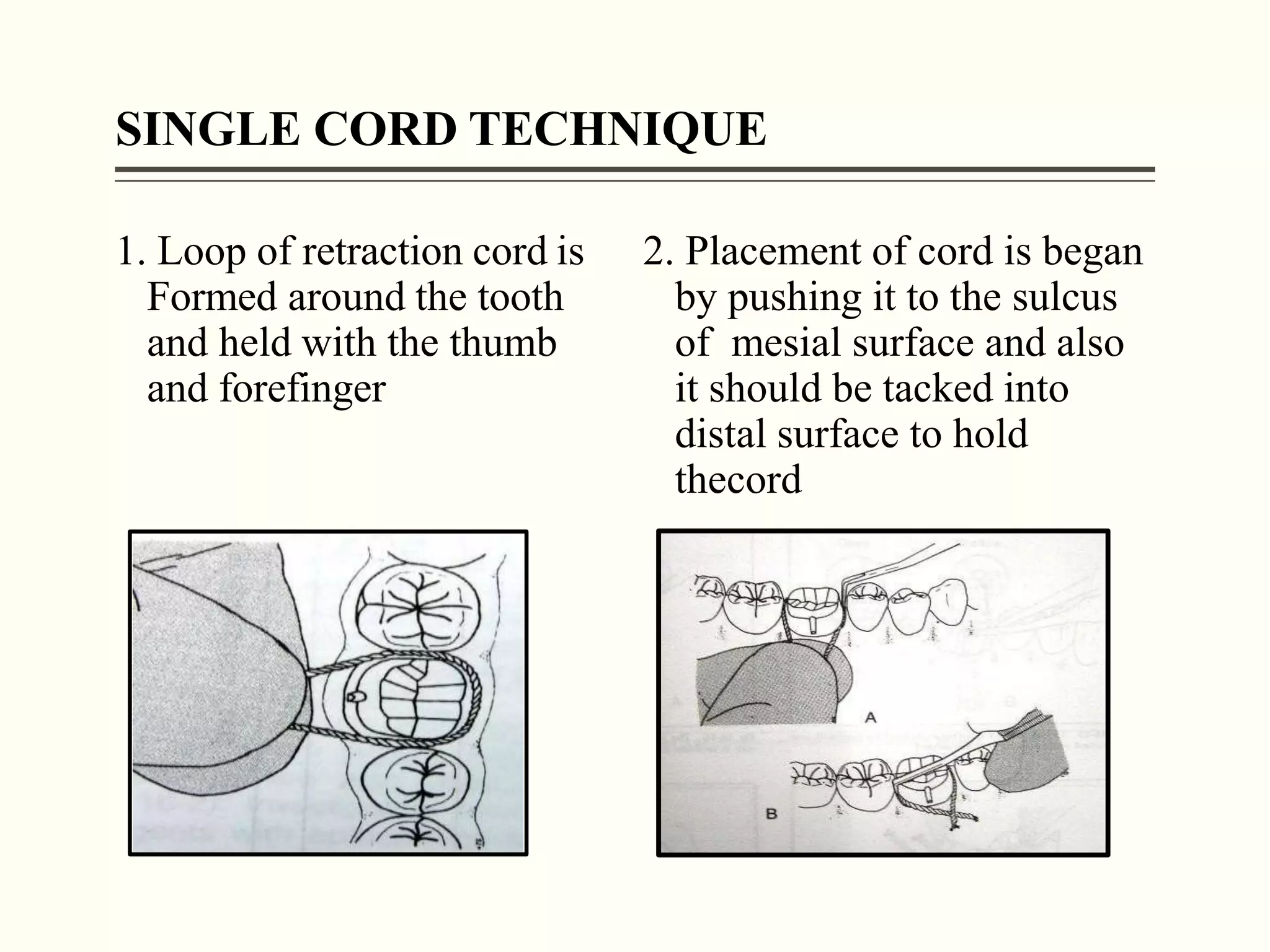 GINGIVAL TISSUE RETRACTION pptx GINGIVAL TISSUE RETRACTION pptx