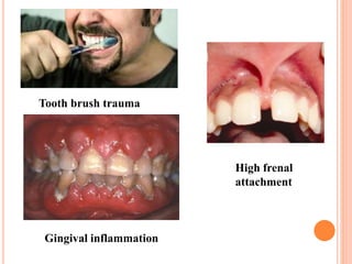 Tooth brush trauma
Gingival inflammation
High frenal
attachment
 