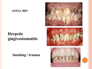 Gingiva (Macroscopic features) | PPTX