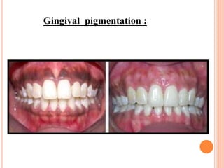Gingival pigmentation :
 