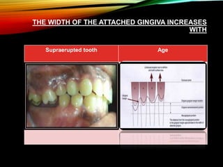 THE WIDTH OF THE ATTACHED GINGIVA INCREASES
WITH
Supraerupted tooth Age
 
