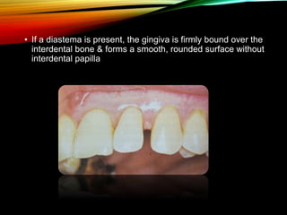 • If a diastema is present, the gingiva is firmly bound over the
interdental bone & forms a smooth, rounded surface without
interdental papilla
 