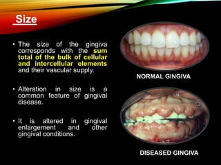 NORMAL GINGIVA
Size
• The size of the gingiva
corresponds with the sum
total of the bulk of cellular
and intercellular elements
and their vascular supply.
• Alteration in size is a
common feature of gingival
disease.
• It is altered in gingival
enlargement and other
gingival conditions.
DISEASED GINGIVA
 