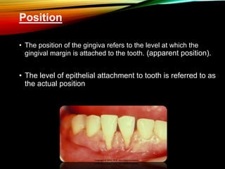 Position
• The position of the gingiva refers to the level at which the
gingival margin is attached to the tooth. (apparent position).
• The level of epithelial attachment to tooth is referred to as
the actual position
 