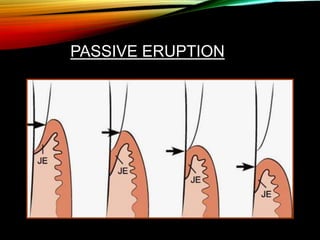 PASSIVE ERUPTION
 