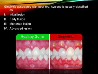 Gingivitis associated with poor oral hygiene is usually classified
as
I. Initial lesion
II. Early lesion
III. Moderate lesion
IV. Advanced lesion
 