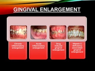 GINGIVAL ENLARGEMENT
Chronic
inflammatory
enlargement
Acute
inflammatory
enlargement
Drug
induced
gingival
enlargement
Vitamin C
deficiency
associated
gingival
enlargement
 
