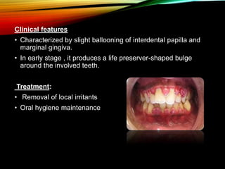 Clinical features
• Characterized by slight ballooning of interdental papilla and
marginal gingiva.
• In early stage , it produces a life preserver-shaped bulge
around the involved teeth.
Treatment:
• Removal of local irritants
• Oral hygiene maintenance
 