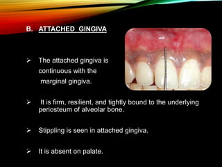 B. ATTACHED GINGIVA
 The attached gingiva is
continuous with the
marginal gingiva.
 It is firm, resilient, and tightly bound to the underlying
periosteum of alveolar bone.
 Stippling is seen in attached gingiva.
 It is absent on palate.
 