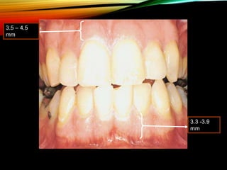 3.5 – 4.5
mm
3.3 -3.9
mm
 