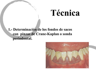 Técnica
1.- Determinación de los fondos de sacos
con pinzas de Crane-Kaplan o sonda
periodontal.
 