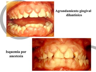 Agrandamiento gingival
dilantínico
Isquemia por
anestesia
 