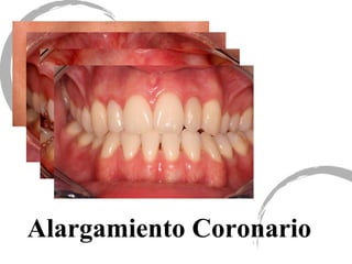 Alargamiento Coronario
 