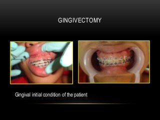 GINGIVECTOMY




Gingival initial condition of the patient
 