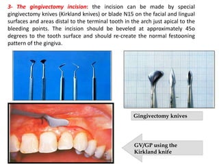 Gingivectomy knives
GV/GP using the
Kirkland knife
3- The gingivectomy incision: the incision can be made by special
gingivectomy knives (Kirkland knives) or blade N15 on the facial and lingual
surfaces and areas distal to the terminal tooth in the arch just apical to the
bleeding points. The incision should be beveled at approximately 45o
degrees to the tooth surface and should re-create the normal festooning
pattern of the gingiva.
 
