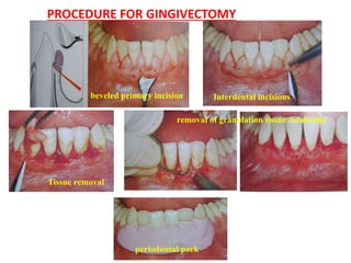 PROCEDURE FOR GINGIVECTOMY
beveled primary incision Interdental incisions
Tissue removal
removal of granulation tissue &calculus
periodontal pack
 