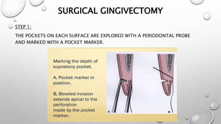 Gingivectomy- Surgical procedure in Periodontics | PPTX
