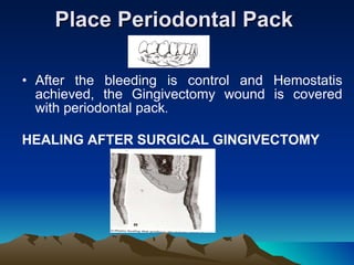 Place Periodontal Pack  After the bleeding is control and Hemostatis achieved, the Gingivectomy wound is covered with periodontal pack .  HEALING AFTER SURGICAL GINGIVECTOMY 