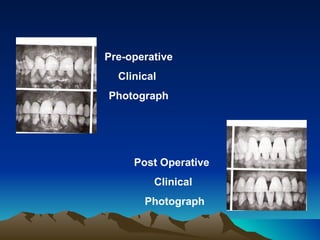 Pre-operative  Clinical  Photograph Post Operative  Clinical  Photograph 