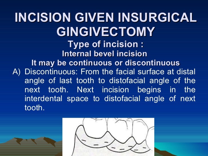 Gingivectomy