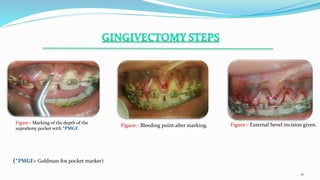 .
10
Figure:- Marking of the depth of the
suprabony pocket with *PMGF.
Figure:- Bleeding point after marking. Figure:- External bevel incision given.
(*PMGF= Goldman fox pocket marker)
 