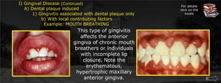 For details click on the booksI) Gingival Disease (Continued)	A) Dental plaque induced		   1) Gingivitis associated with dental plaque only			     b) With local contributing factors				  Example: MOUTH BREATHINGThis type of gingivitis affects the anterior gingiva of chronic mouth breathers or individuals with incomplete lip closure. Note the erythematous, hypertrophic maxillary anterior gingiva.