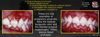 I) Gingival Disease (Continued)     A) Dental plaque induced        2) Gingival diseases modified by systemic factors		   a) Associated with endocrine system	               3) PREGNANCY GINGIVITISFor details click on the booksThese are two examples of pregnancy gingivitis. Note the intense burgundy color and the marked gingival hypertrophy. These lesions bleed profusely.