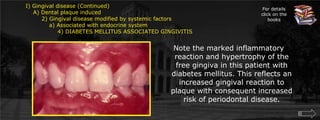 For details click on the books Gingival disease (Continued)    A) Dental plaque induced	2) Gingival disease modified by systemic factors	    a) Associated with endocrine system		4) DIABETES MELLITUS ASSOCIATED GINGIVITISNote the marked inflammatory reaction and hypertrophy of the free gingiva in this patient with diabetes mellitus. This reflects an increased gingival reaction to plaque with consequent increased risk of periodontal disease.
