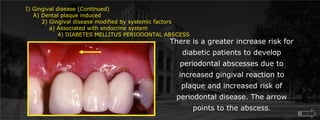 I) Gingival disease (Continued)    A) Dental plaque induced	2) Gingival disease modified by systemic factors	    a) Associated with endocrine system		4) DIABETES MELLITUS PERIODONTAL ABSCESSThere is a greater increase risk for diabetic patients to develop periodontal abscesses due to increased gingival reaction to plaque and increased risk of periodontal disease. The arrow points to the abscess.