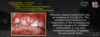 I) Gingival disease (Continued)    A) Dental plaque induced	3) Gingival diseases modified by medications	    a) Drug induced gingival disease		1) PHENYTOIN GINGIVAL HYPERTHROPHYFor details click on the booksPhenytoin gingival hypertrophy has an incidence of 3 to 84.5%. This enlargement is produced by hyperplasia of the connective and epithelial tissues with secondary inflammation. It may have increased expression of platelet derived growth factor.