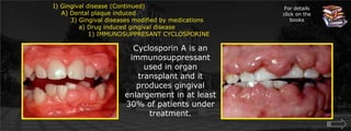 I) Gingival disease (Continued)    A) Dental plaque induced	3) Gingival diseases modified by medications	    a) Drug induced gingival disease		1) IMMUNOSUPPRESANT CYCLOSPORINEFor details click on the booksCyclosporin A is an immunosuppressant used in organ transplant and it produces gingival enlargement in at least 30% of patients under treatment.