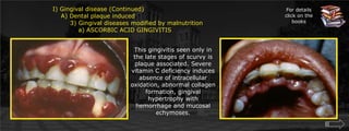 I) Gingival disease (Continued)    A) Dental plaque induced	3) Gingival diseases modified by malnutrition	    a) ASCORBIC ACID GINGIVITISFor details click on the booksThis gingivitis seen only in the late stages of scurvy is plaque associated. Severe vitamin C deficiency induces absence of intracellular oxidation, abnormal collagen formation, gingival hypertrophy with hemorrhage and mucosal echymoses.
